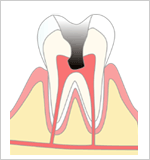 C３.の歯