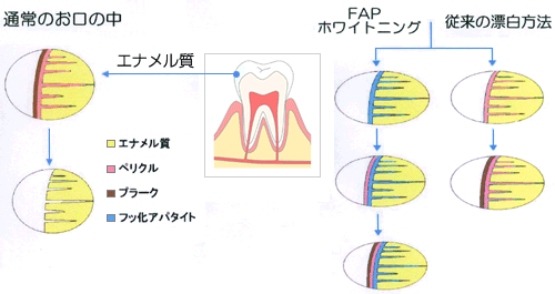 ホワイトニングをした歯の表面説明図